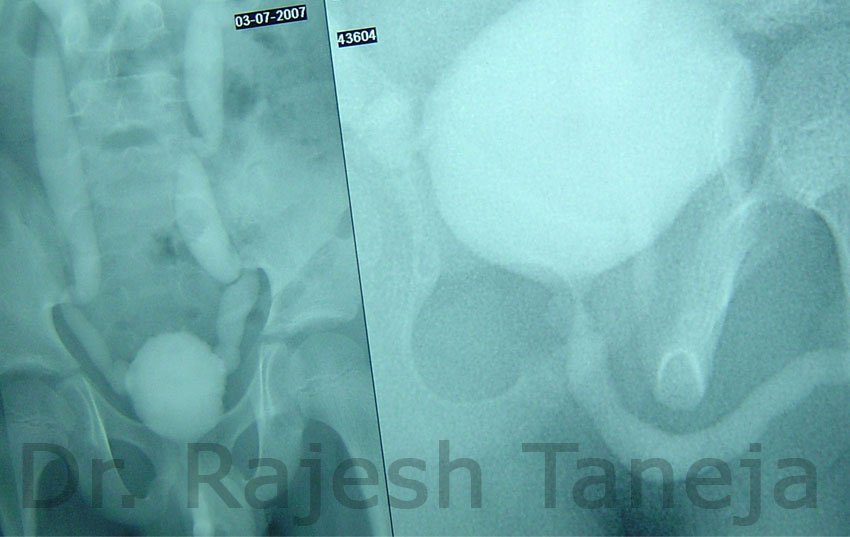 Bilateral VUR in a Male Child