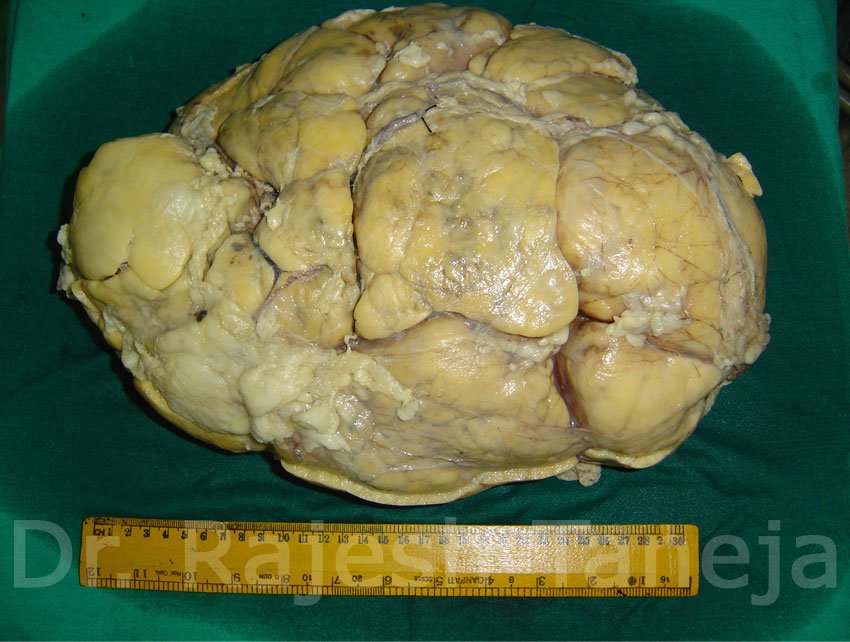 Heaviest Kidney Tumour ever removed