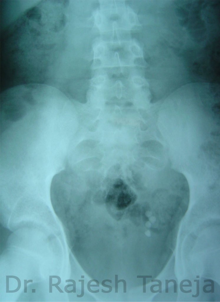 Megaureter -Xrays