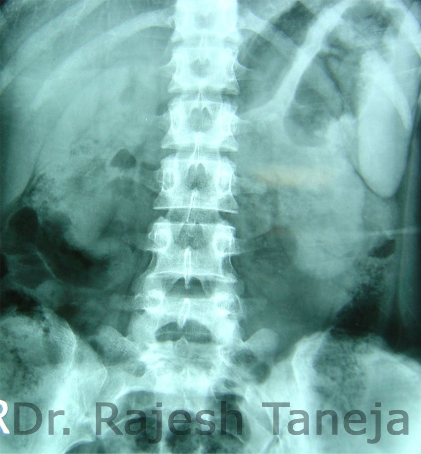 pelvi ureteric junction obstruction