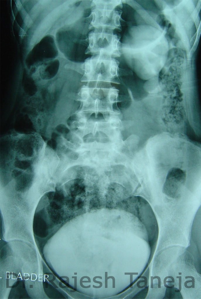 pelvi ureteric junction obstruction