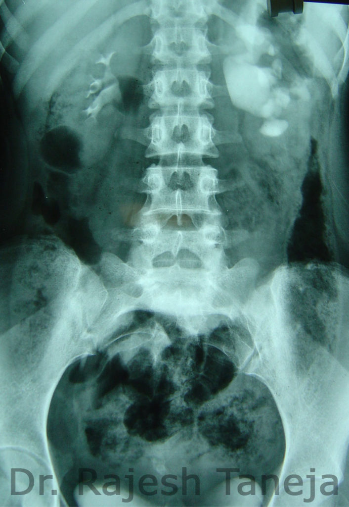 pelvi ureteric junction obstruction