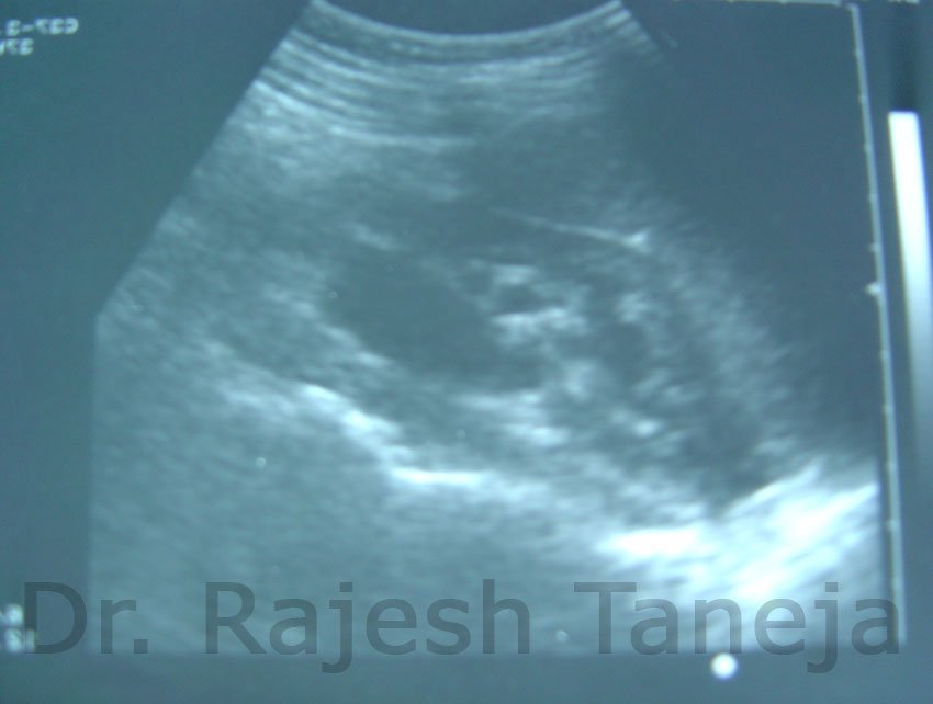 pelvi ureteric junction obstruction