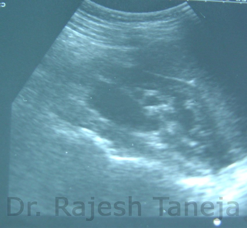 pelvi ureteric junction obstruction