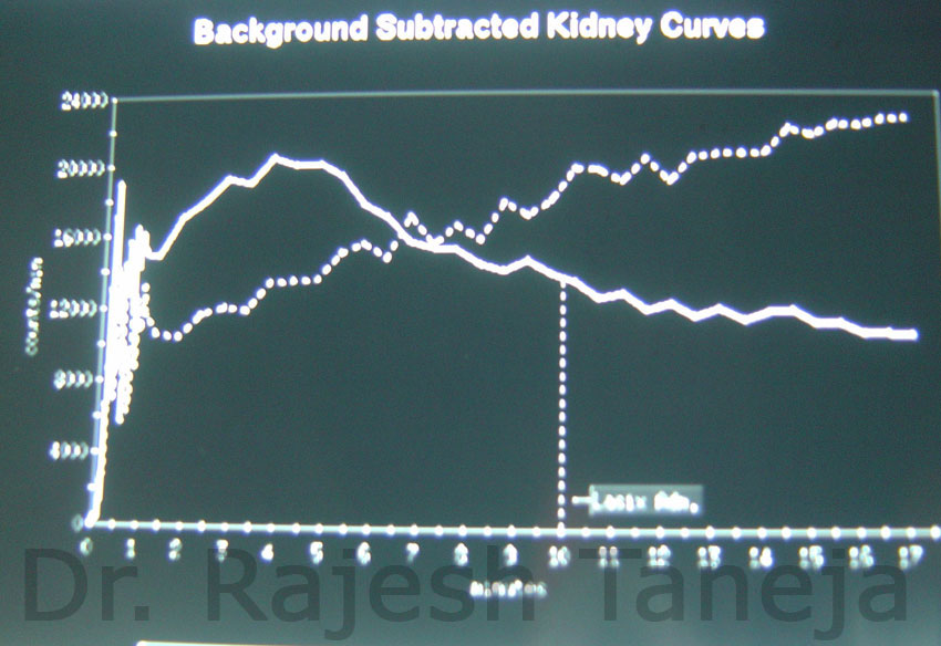 pelvi ureteric junction obstruction