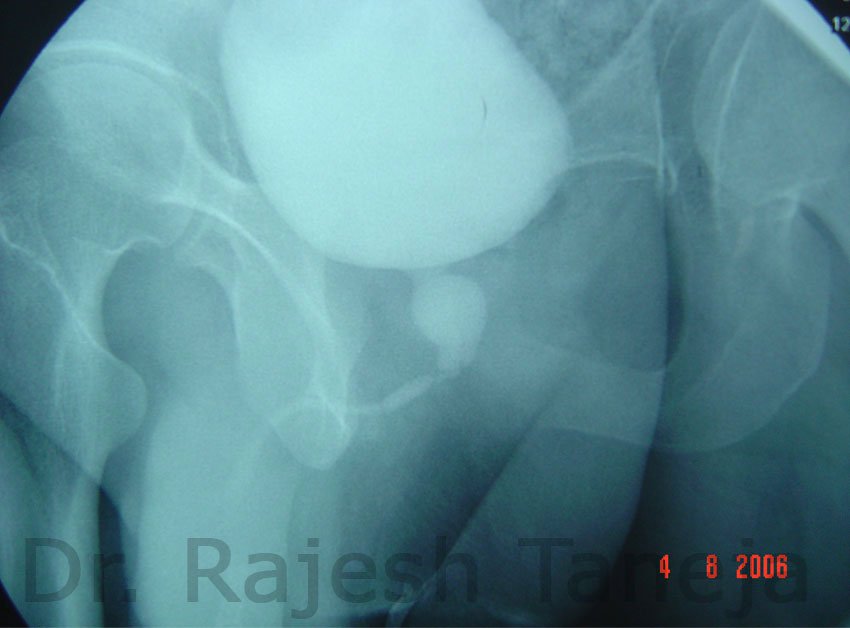 Posterior Urethral Valves