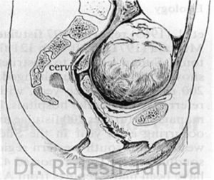 Vesicovaginal fistula