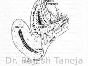 Vesicovaginal fistula