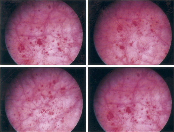 A case of painful bladder syndrome/ interstitial cystitis diagnosed by urodynamics, cystometry and cystoscopy and managed successfully using pentosan polysulfate