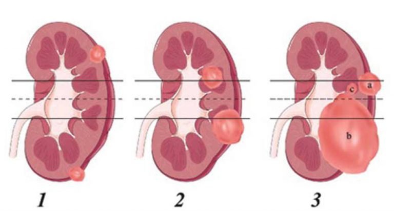 Role of Robotic Partial Nephrectomy in treatment of Renal Cell Carcinoma