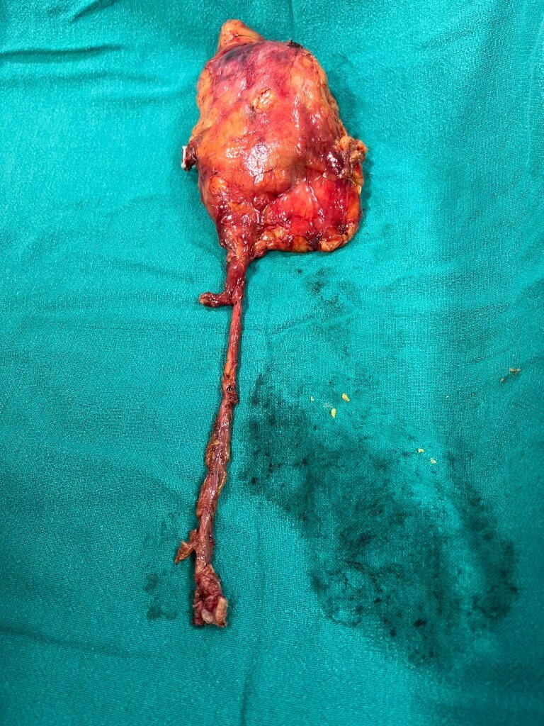 Radical Nephroureterectomy with excision of cuff of bladder